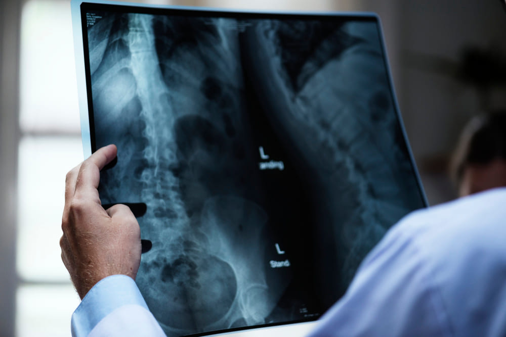 Tratamiento para escoliosis en Querétaro